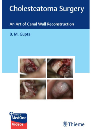 Cholesteatoma Surgery
