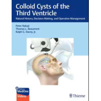 Colloid Cysts of the Third Ventricle