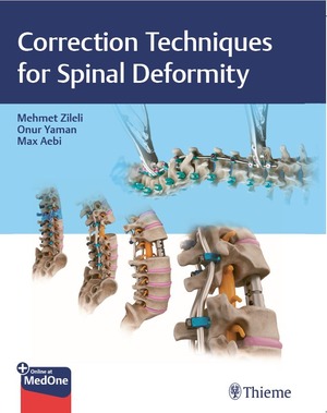 Correction Techniques for Spine Deformity